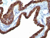 IHC: Formalin-fixed, paraffin-embedded human ovarian carcinoma stained with Cytokeratin 7 antibody (KRT7/760 + OV-TL12/30).