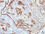 IHC: Formalin-fixed, paraffin-embedded human lung carcinoma stained with Cytokeratin 7 antibody (KRT7/760 + OV-TL12/30)