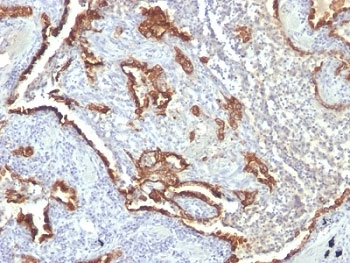 IHC: Formalin-fixed, paraffin-embedded human lung carcinoma