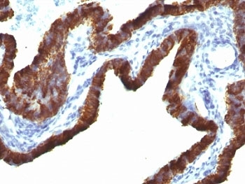 IHC: Formalin-fixed, paraffin-embedded human ovarian carcinoma stained with Cytokeratin 7 antibody (KRT7/760 + OV-TL12/30)~