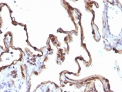 IHC: Formalin-fixed, paraffin-embedded human lung carcinoma stained with Keratin 7 antibody (KRT7/1198)