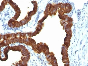 IHC: Formalin-fixed, paraffin-embedded human ovarian carcinoma stained with Keratin 7 antibody (KRT7/1198)~