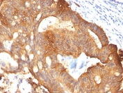 IHC: Formalin-fixed, paraffin-embedded colon carcinoma stained with Cytokeratin 8 antibody (clone B22.1). HIER: boil tissue sections in pH 9 10mM Tris with 1mM EDTA for 20 min and allow to cool before testing.