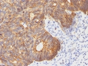 IHC: Formalin-fixed, paraffin-embedded human colon carcinoma stained with Cytokeratin 8 antibody (clone C-43).