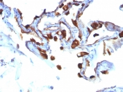 IHC: Formalin-fixed, paraffin-embedded human lung carcinoma stained with Keratin 8 antibody (KRT8/803).