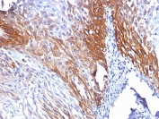 IHC: Formalin-fixed, paraffin-embedded human cervical carcinoma stained with Cytokeratin 17 antibody (KRT17/778).