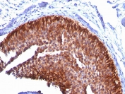 IHC: Formalin-fixed, paraffin-embedded human bladder carcinoma stained with Cytokeratin 17 antibody (KRT17/778).
