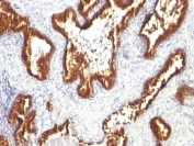 IHC: Formalin-fixed, paraffin-embedded human prostate carcinoma stained with Keratin 18 antibody (clone KRT18/1190).