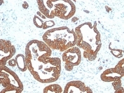 IHC analysis of formalin-fixed, paraffin-embedded human colon carcinoma stained with Cytokeratin 18 antibody (clone DE-K18).