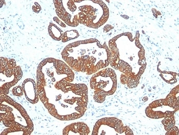IHC analysis of formalin-fixed, paraffin-embedded human colon carcinoma stained with Cytokeratin 18 antibody (clone DE-K18).~
