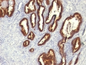IHC: Formalin-fixed, paraffin-embedded human prostate carcinoma stained with Cytokeratin 18 antibody (KRT18/834).
