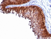 IHC: Formalin-fixed, paraffin-embedded human bladder carcinoma stained with Cytokeratin 18 antibody (KRT18/834).