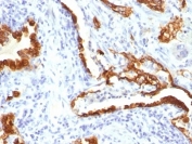 IHC: Formalin-fixed, paraffin-embedded human lung carcinoma stained with Cytokeratin 18 antibody (KRT18/834).