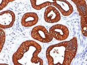 IHC: Formalin-fixed, paraffin-embedded human colon carcinoma stained with Cytokeratin 18 antibody (KRT18/834).