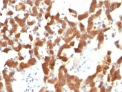 IHC: Formalin-fixed, paraffin-embedded human thyroid carcinoma stained with Cytokeratin 18 antibody (KRT18/834).