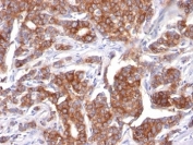 IHC: Formalin-fixed, paraffin-embedded human breast carcinoma stained with Cytokeratin 18 antibody (KRT18/834).