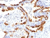 IHC: Formalin-fixed, paraffin-embedded human lung carcinoma stained with Cytokeratin 18 antibody (clone KRT18/835).