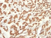 IHC: Formalin-fixed, paraffin-embedded human thyroid carcinoma stained with Cytokeratin 18 antibody (KRT18/835).