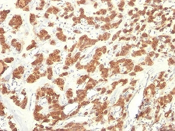 IHC: Formalin-fixed, paraffin-embedded human thyroid carcinoma stained with Cytokeratin 18 antibody (KRT18/835).