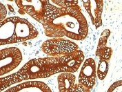 IHC: Formalin-fixed, paraffin-embedded human colon carcinoma stained with Cytokeratin 18 antibody (clone KRT18/835).