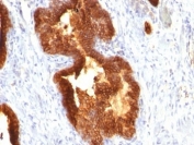 IHC: Formalin-fixed, paraffin-embedded human prostate carcinoma stained with Cytokeratin 18 antibody (clone KRT18/835).