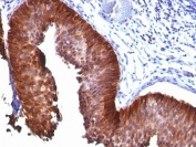 IHC: Formalin-fixed, paraffin-embedded human bladder carcinoma stained with Cytokeratin 18 antibody (KRT18/835).