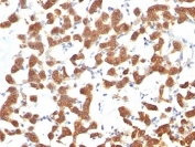IHC analysis of formalin-fixed, paraffin-embedded human thyroid carcinoma stained with Keratin 18 antibody (clone C-04).