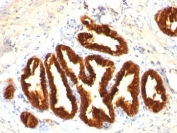 IHC: Formalin-fixed, paraffin-embedded human prostate carcinoma stained with Cytokeratin 18 antibody.