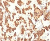 IHC: Formalin-fixed, paraffin-embedded human thyroid carcinoma stained with Cytokeratin 18 antibody.