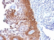 IHC: Formalin-fixed, paraffin-embedded human cervical carcinoma stained with Cytokeratin 18 antibody.