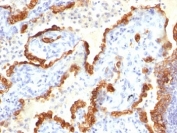 IHC: Formalin-fixed, paraffin-embedded human lung carcinoma stained with Cytokeratin 18 antibody.