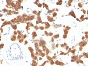 IHC analysis of formalin-fixed, paraffin-embedded human thyroid carcinoma stained with CK18 antibody (clone B23.1).