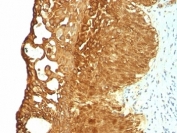 IHC: Formalin-fixed, paraffin-embedded human cervical carcinoma stained with Cytokeratin 19 antibody (KRT19/799).