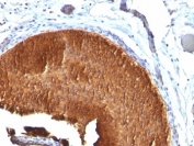 IHC: Formalin-fixed, paraffin-embedded human bladder carcinoma stained with Cytokeratin 19 antibody (KRT19/799).
