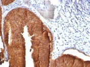 IHC: Formalin-fixed, paraffin-embedded human bladder carcinoma stained with CK19 antibody (KRT19/800)