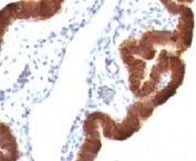 IHC: Formalin-fixed, paraffin-embedded human ovarian carcinoma stained with Cytokeratin 19 antibody (KRT19/799 + KRT19/800).