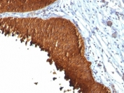 IHC: Formalin-fixed, paraffin-embedded human bladder carcinoma stained with Cytokeratin 19 antibody (KRT19/799 + KRT19/800).