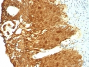 IHC: Formalin-fixed, paraffin-embedded human cervical carcinoma stained with Cytokeratin 19 antibody (KRT19/799 + KRT19/800).