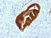IHC: Formalin-fixed, paraffin-embedded human endometrial carcinoma stained with Cytokeratin 19 antibody (KRT19/799 + KRT19/800).