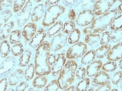 IHC: Formalin-fixed, paraffin-embedded human renal cell carcinoma stained with Laminin gamma 1 antibody (clone A5).