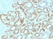 IHC: Formalin-fixed, paraffin-embedded human renal cell carcinoma stained with Laminin gamma 1 antibody (clone SPM193).