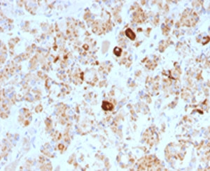 IHC testing of formalin-fixed, paraffin-embedded human pituitary stained with Luteinizing Hormone beta antibody (clone SPM103).~