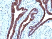 IHC: Formalin-fixed, paraffin-embedded human ovarian carcinoma stained with EpCAM antibody (clone EGP40/1110).