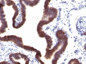 IHC: Formalin-fixed, paraffin-embedded human ovarian carcinoma stained with EpCAM antibody (EGP40/1120).