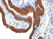 IHC: Formalin-fixed, paraffin-embedded human ovarian carcinoma stained with EpCAM antibody (SPM491).