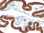 Formalin-fixed, paraffin-embedded human ovarian carcinoma stained with anti-EpCAM antibody (clone SPM134).