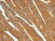 IHC: Formalin-fixed, paraffin-embedded human colon carcinoma stained with EpCAM antibody (MOC-31).