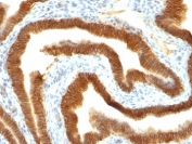 IHC: Formalin-fixed, paraffin-embedded human ovarian carcinoma stained with EpCAM antibody (MOC-31).