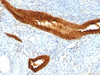 IHC: Formalin-fixed, paraffin-embedded human endometrial carcinoma stained with EpCAM antibody (MOC-31).~