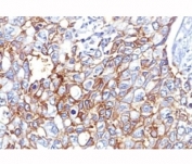 IHC: Formalin-fixed, paraffin-embedded human breast carcinoma stained with EpCAM antibody (EGP40/826).
